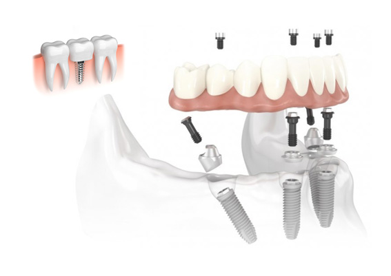 implantes de carga inmediata