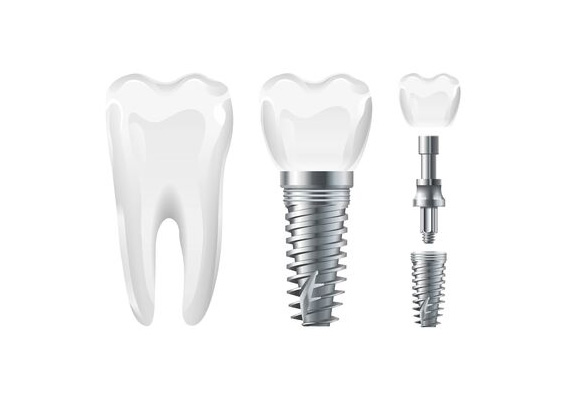 implantes dentales guadalajara