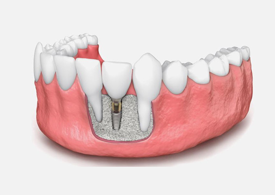 implantes dentales sin hueso