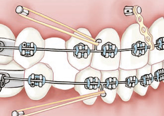 microimplantes dentales